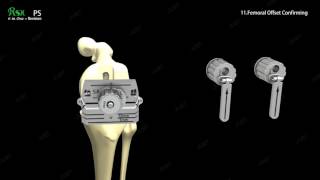 RSK Revision Total Knee