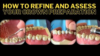 How to Refine and Assess your Crown Preparation ? GIVEAWAY VIDEO DEMO