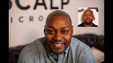 NEW Scalp Micropigmentation Before and After | Scalp Micro USA