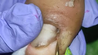 Part 2 Ang Kakapal Ng Mga Dry Skin Ng Paa Ni Client