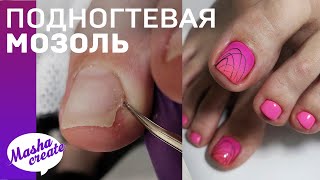 видео: Болят уголки ногтей 🙈  удаление подногтевой мозоли. Градиент гель лаком в педикюре. картинка: Болят уголки ногтей 🙈  удаление подногтевой мозоли. Градиент гель лаком в педикюре.