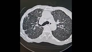 Full Miliary Tuberculosis Guide