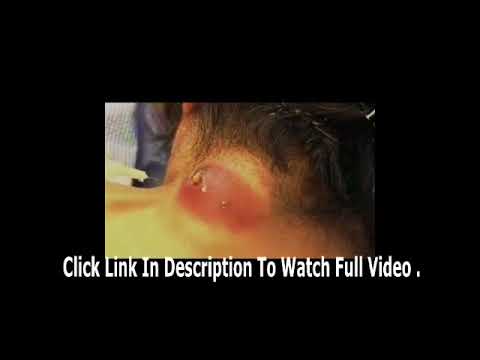 acne treatment at home    squeeze pimple on the neck   squeeze acne horror   YouTube