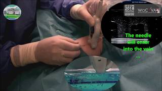 Túnel de Eirís: Uniportal tunneling of PICC versus classic in a Critical Care Unit. Resimi