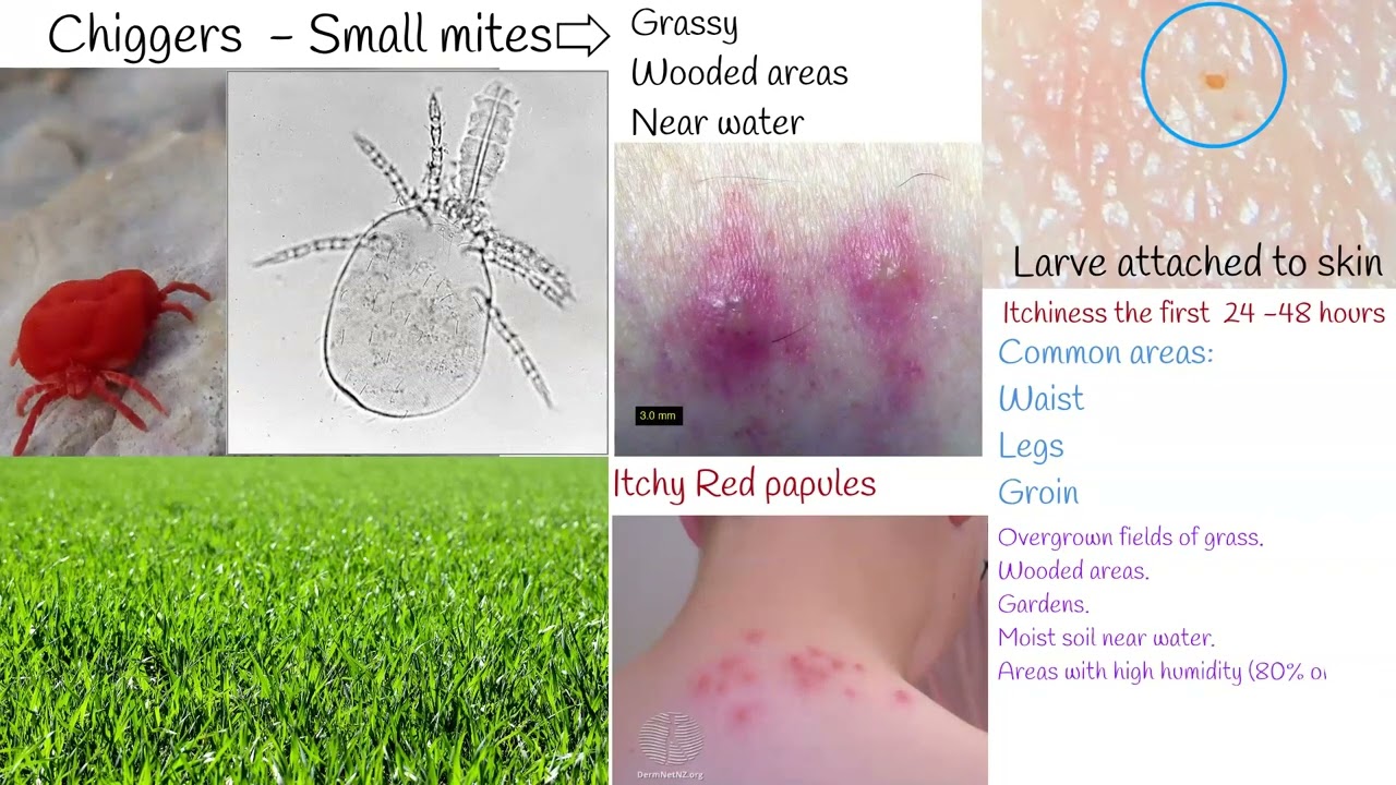 Chiggers Bite Red Bugs Harvest Mites Symptoms And Treatment Youtube