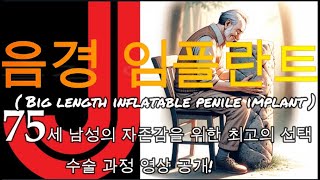 75세 남성의 자존감을 위한 최고의 선택! 음경 임플란트! (Big length inflatable Penile implant) 수술 과정!
