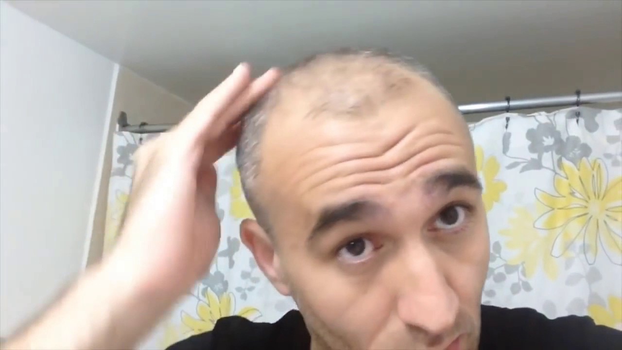 Video Cara Menggunakan Minoxidil Untuk Rambut Botak YouTube