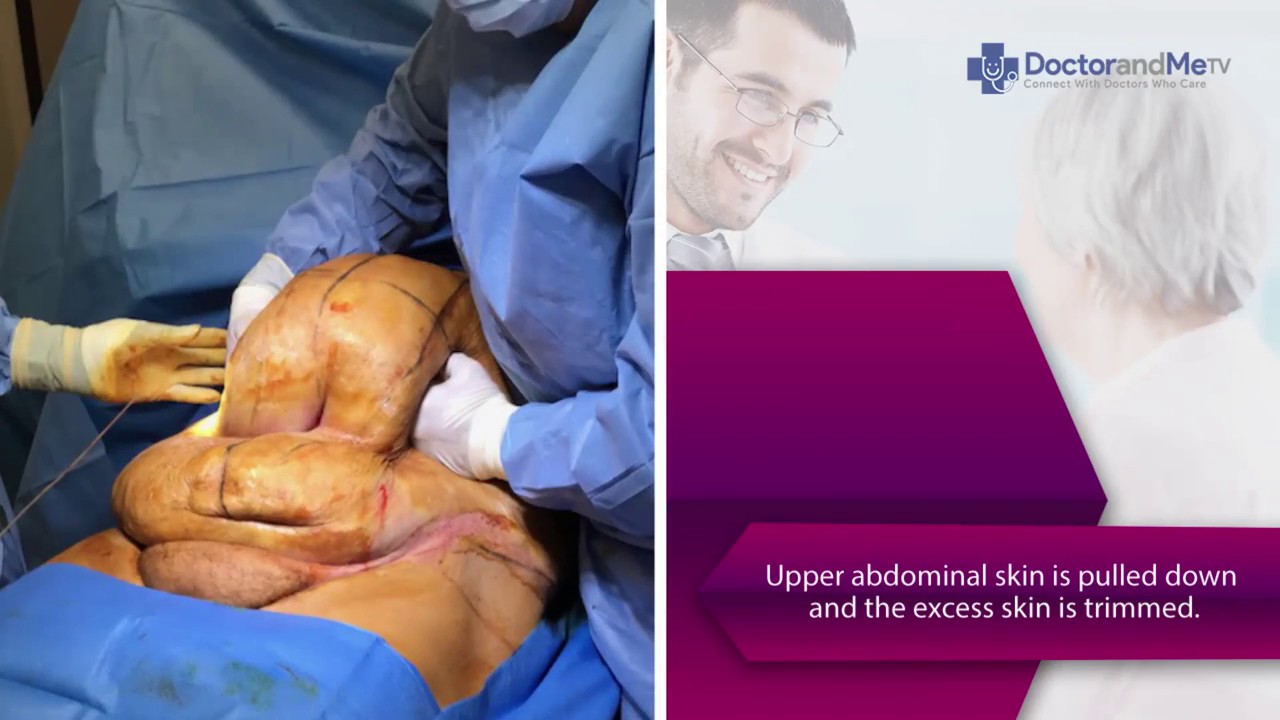 Abdominoplasty Tummy Tuck In Frisco Plano Nagarkar