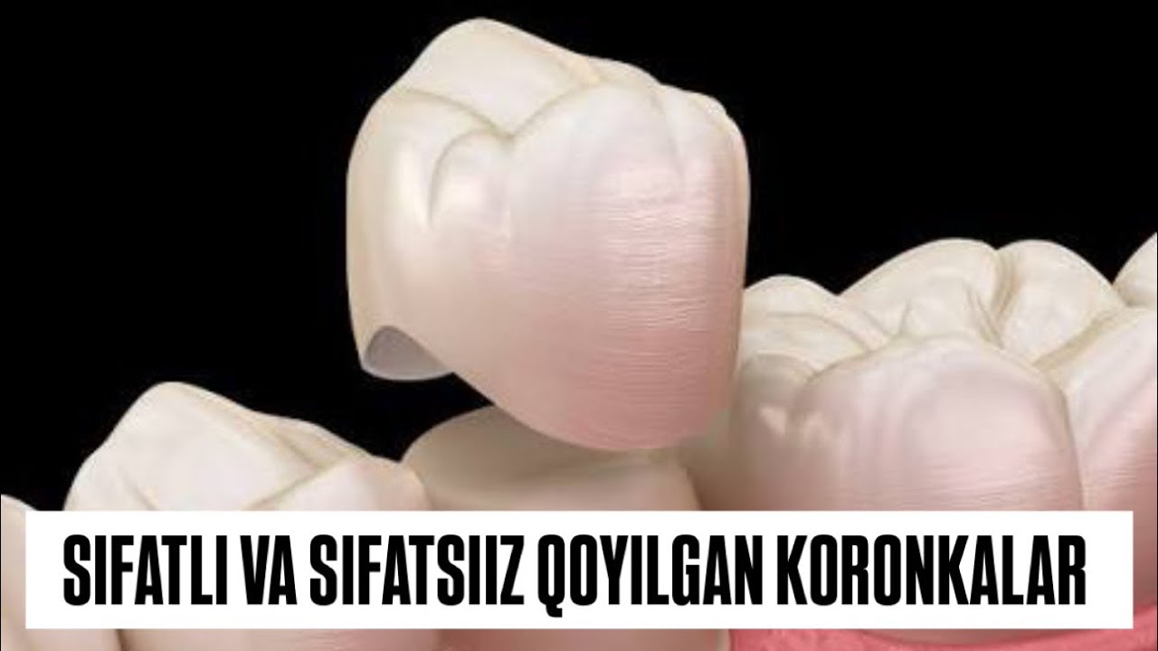 Sifatli va sifatsiz qo’yilgan koronkalar #shifokor#dentist#doctor#tibbiyot#rek#tibbiyot 