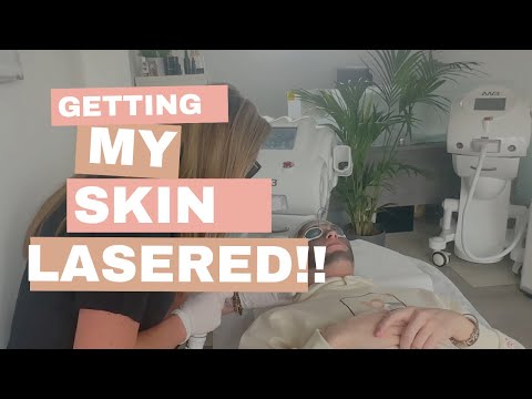 GETTING MY SKIN LASERED (IT HURT SO MUCH!) #skits #spa #skintreatment