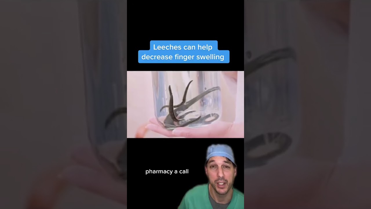 We still use leeches! 