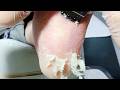 Foot care: Remove dead skin and debris from the soles of your feet.【Dr. Zhang】