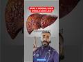 Fatty liver natural cures weight loss holistic #healthytips