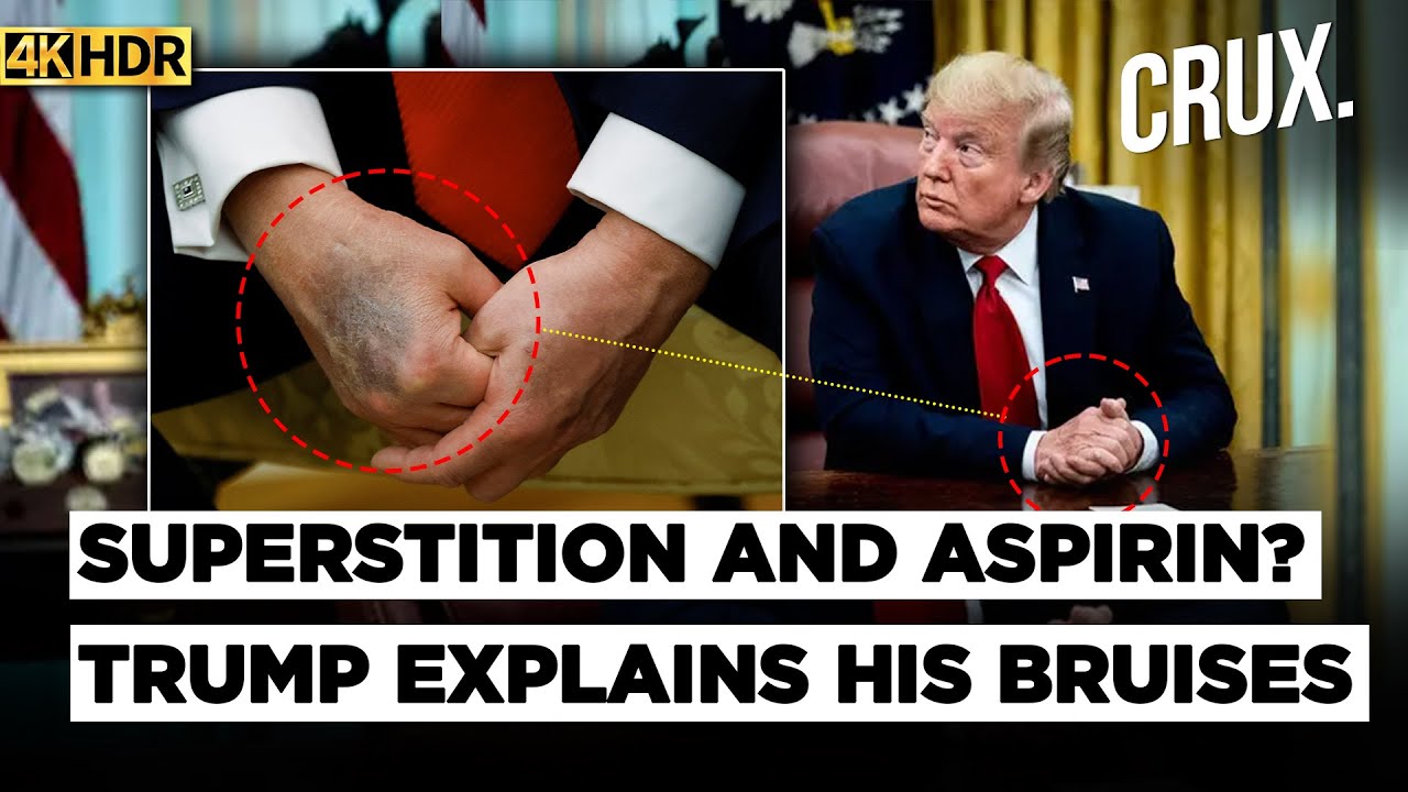 "I Want Nice, Thin Blood" Donald Trump Blames Higher Aspirin Dosage For Mysterious Hand Bruises | 4K