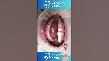 Răng Không Mài Là Như Thế Nào? |Dr Cường Official