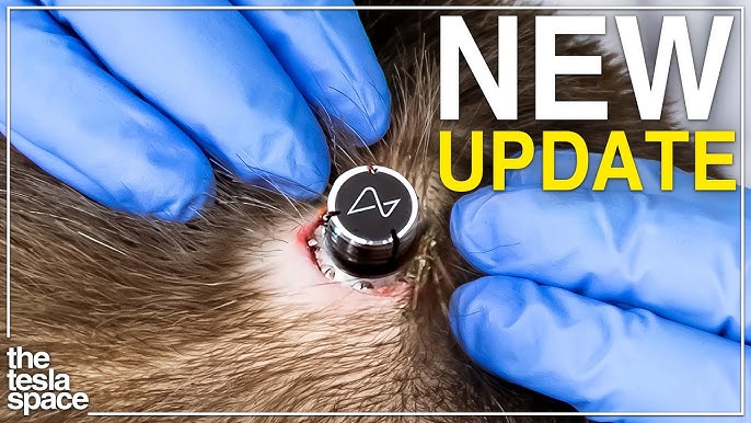Neuralink Reveals Major NEW Human Trial Update! - YouTube