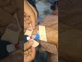 IV cannula technique video part 70 #hopital #motivationql