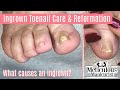 👣How to Pedicure Foot Care Tips on an Ingrown Toenail👣