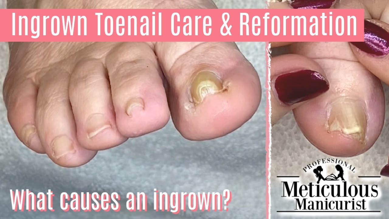 👣How to Pedicure Foot Care Tips on an Ingrown Toenail👣 YouTube