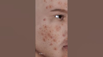 What Exactly Is Acne, Causes of Acne: 3D Animation