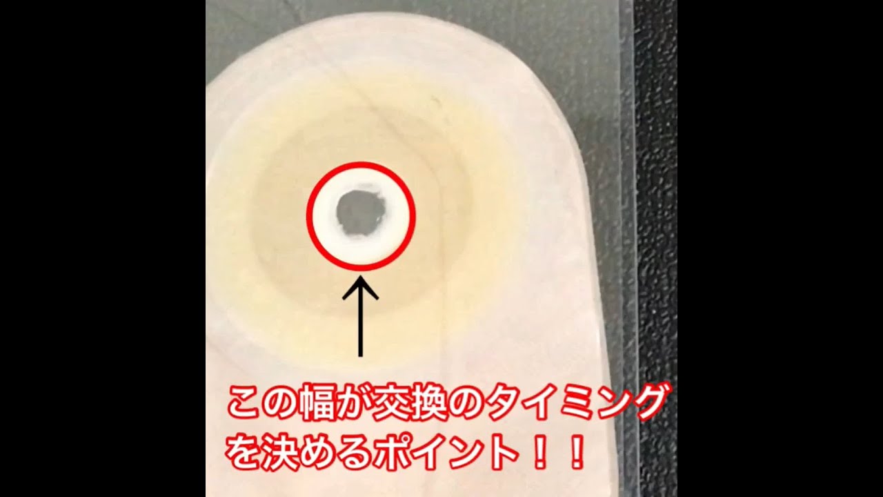 ストーマ装具交換のタイミングはいつ？ - YouTube