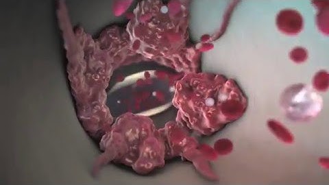 What Are the Symptoms of a Blood Clot in Your Lung? | WebMD