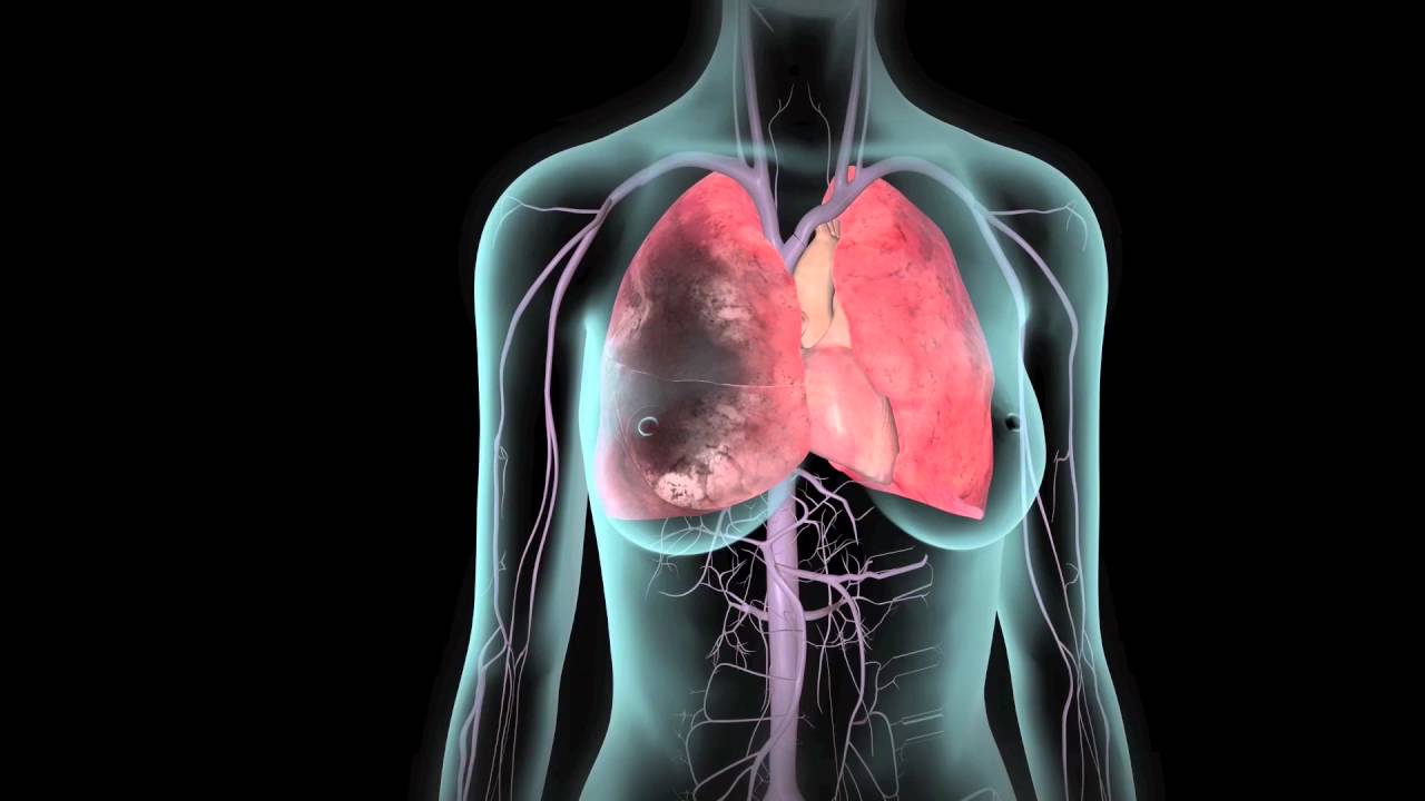 How Do You Know You Have Blood Clots In Your Lungs?