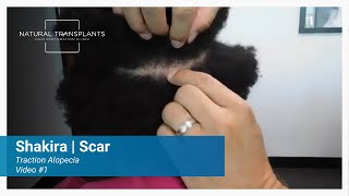 Fine Pencil Line Scar: Incredible Healing After Hair Transplant |  Dr. Siegel (Shakira)