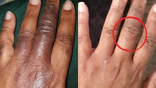 How To Get Rid of Hyperpigmentation - A Natural Method