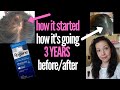 HONEST TALK ABOUT HOW ROGAINE IS WORKING FOR ME 3 YEARS LATER Women's Hair Loss Sufferer & NOT AN AD