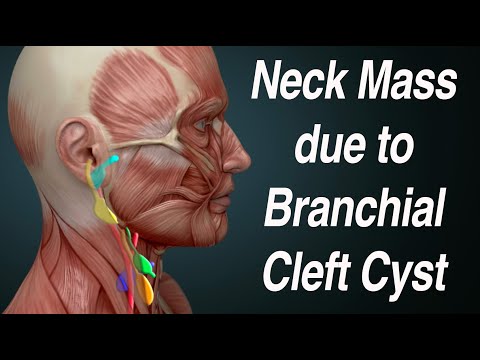 Neck Mass Due to Branchial Cleft Cyst