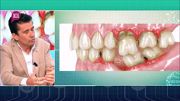 ¿Qué aspecto tiene la pérdida de hueso en los dientes?