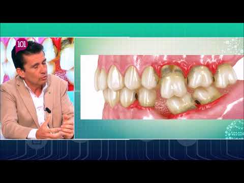 Dr. Cuevas responde -5- Regeneración, Preservación, Pérdida de hueso- Clínica Dental Cuevas Queipo