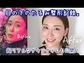 目の下、限界だったので整形しました。【裏ハムラ法】