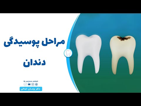 تصویری: 3 راه برای درمان پوسیدگی دندان