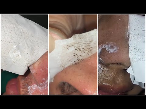 Extremely satisfying nose pore strips peel, for blackheads and pimples TikTok compilation : pt. 2 :