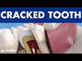 Cracked Tooth and Dental Fractures - Types and how to treat broken teeth
