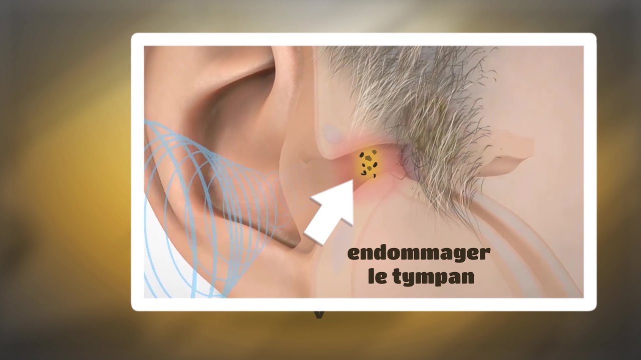 Comment déboucher une oreille en cas de bouchon de cérumen ?