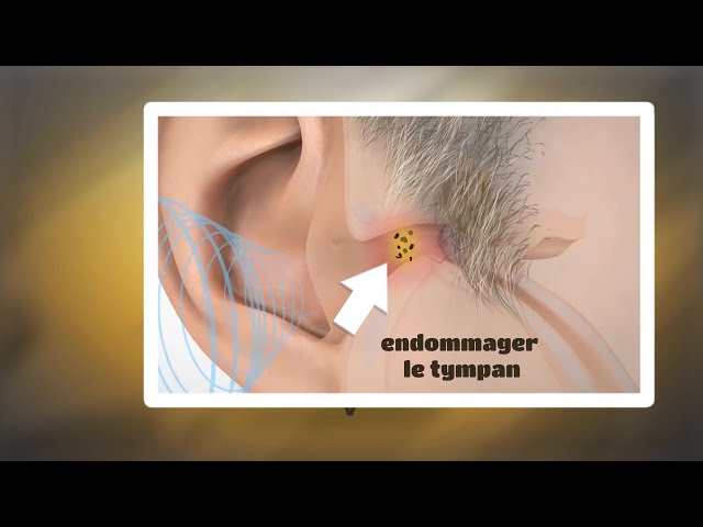 Bouchon d'oreille : les vidéos d'extraction sur