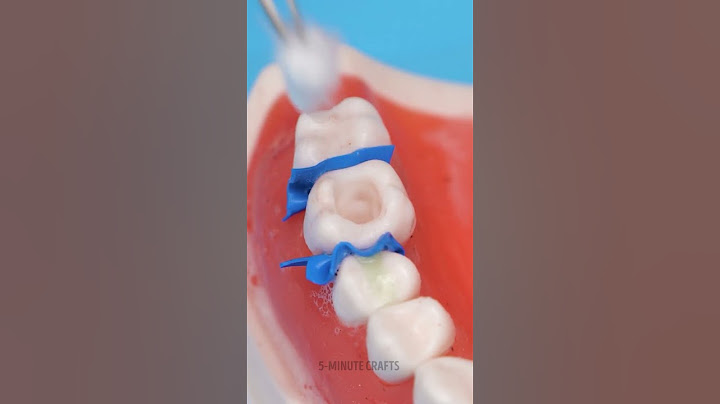 What Removing a Cavity Looks Like Through a Doctor’s Eyes! 🦷