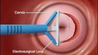 Loop Electrosurgical Excision Procedure LEEP Surgery to remove abnormal, precancerous cells from cer