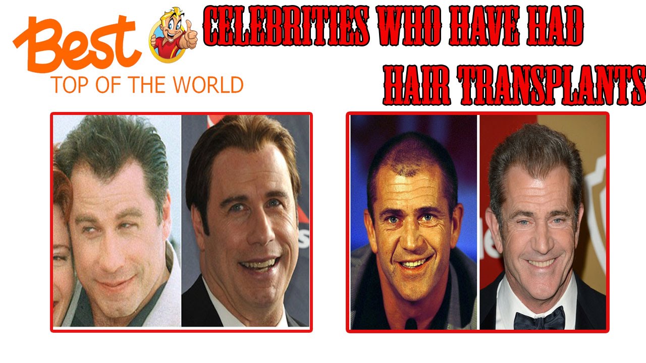 Best Top Of The World Celebrities Who Have Had Hair Transplants