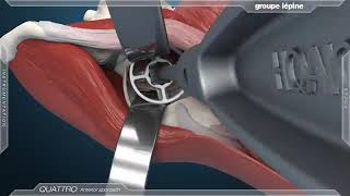 Anterior Approach  Dual Mobility Acetabular Component 3D Animation