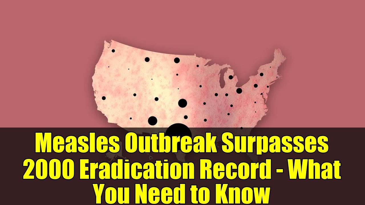 Measles Outbreak Surpasses 2000 Eradication Record - What You Need to Know