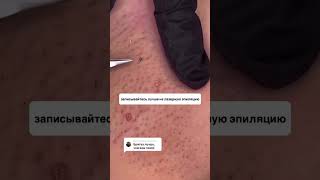 Дapим каждому 10 000 рублей на эпиляцию по ссылке в шапке профиля👉🏻