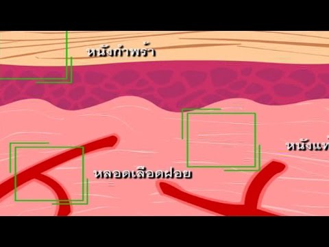 การป้องกันและกำจัดสิ่งแปลกปลอมของร่างกาย วิทยาศาสตร์ ม.4-6 (ชีวะ)