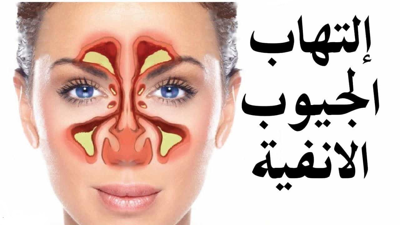 التهاب الجيوب الأنفية الأعراض والأسباب والعلاج Rhinosinusitis - YouTube