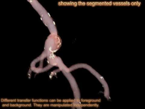 Interactive 3D segmentation of medical images