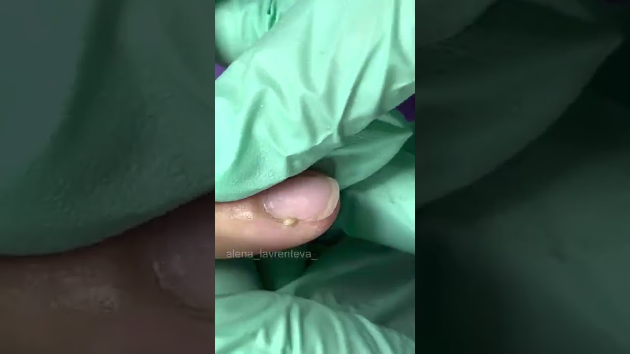 оторвала заусенец / Гной на пальце / загноился палец? / Опух палец, что делать? #Shorts