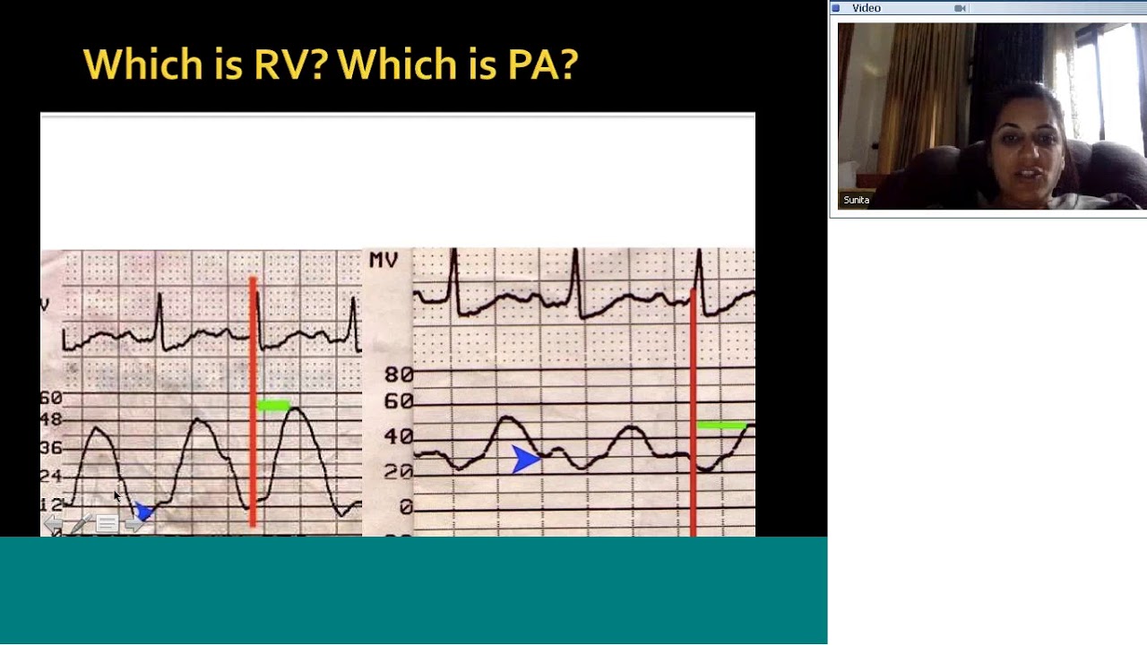 Pedicardio classes on Cardiac cath tracings, pressures Quiz by Dr Sunita Maheshwari